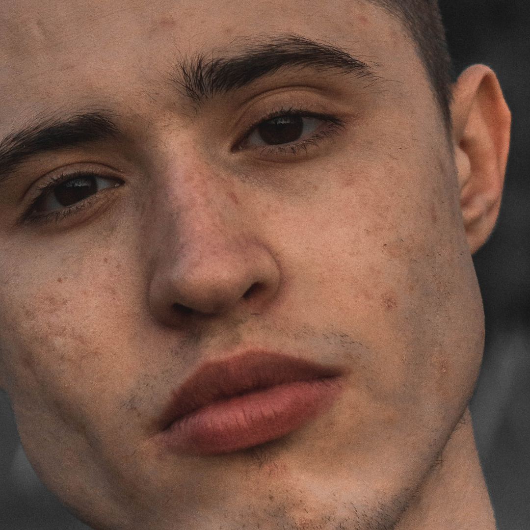 Learn: Managing Troublesome Skin